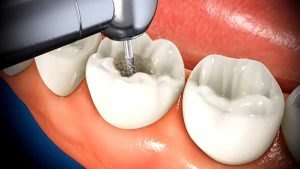 راه های عصب کشی دندان