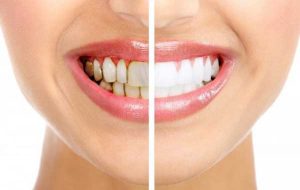 راه های جلوگیری از لک شدن دندان