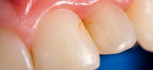 درمان تغییر رنگ دندان