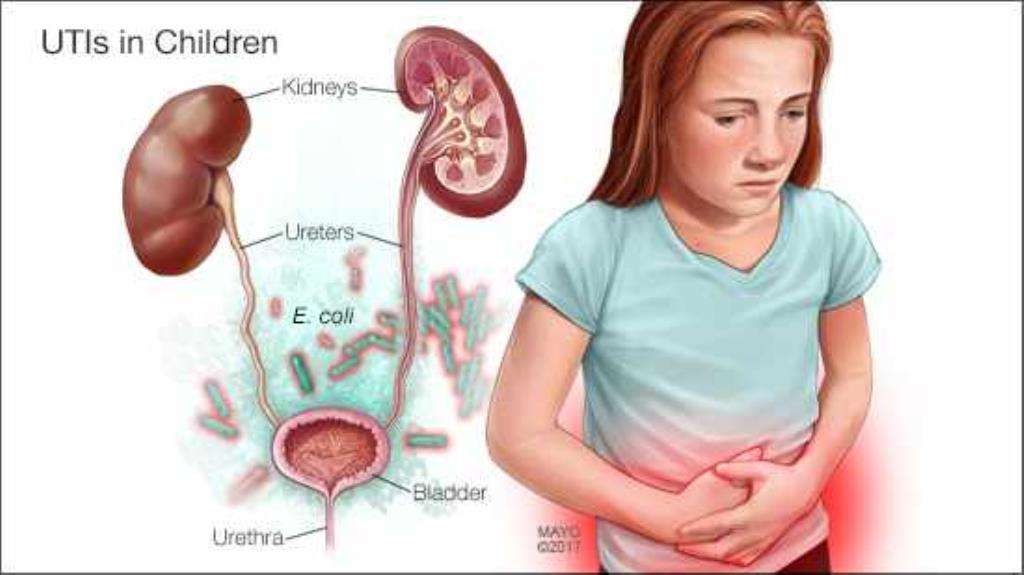 عفونت های ادراری علت عفونت های ادراری عفونت ادراری واگیرداره؟