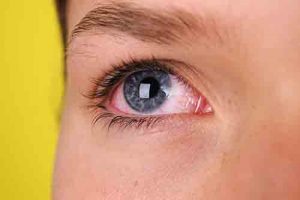 چشم درد سمپاتیک چیست