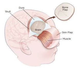تصویری از سر و مغز ؛ جراحی تومور مغزی