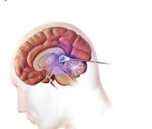 جراحی تومور مغزی چیست