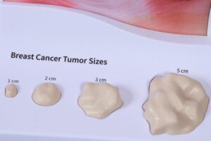 تشخیص سرطان سینه 