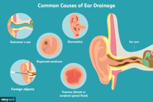 ترشحات گوش را چگونه درمان می کنید؟